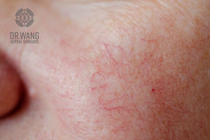 Diagnostics of Skincare Issues, the Organs that are Affected (Eczema and Rosacea)