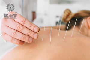How Acupuncture Can Help Your Overall Wellness